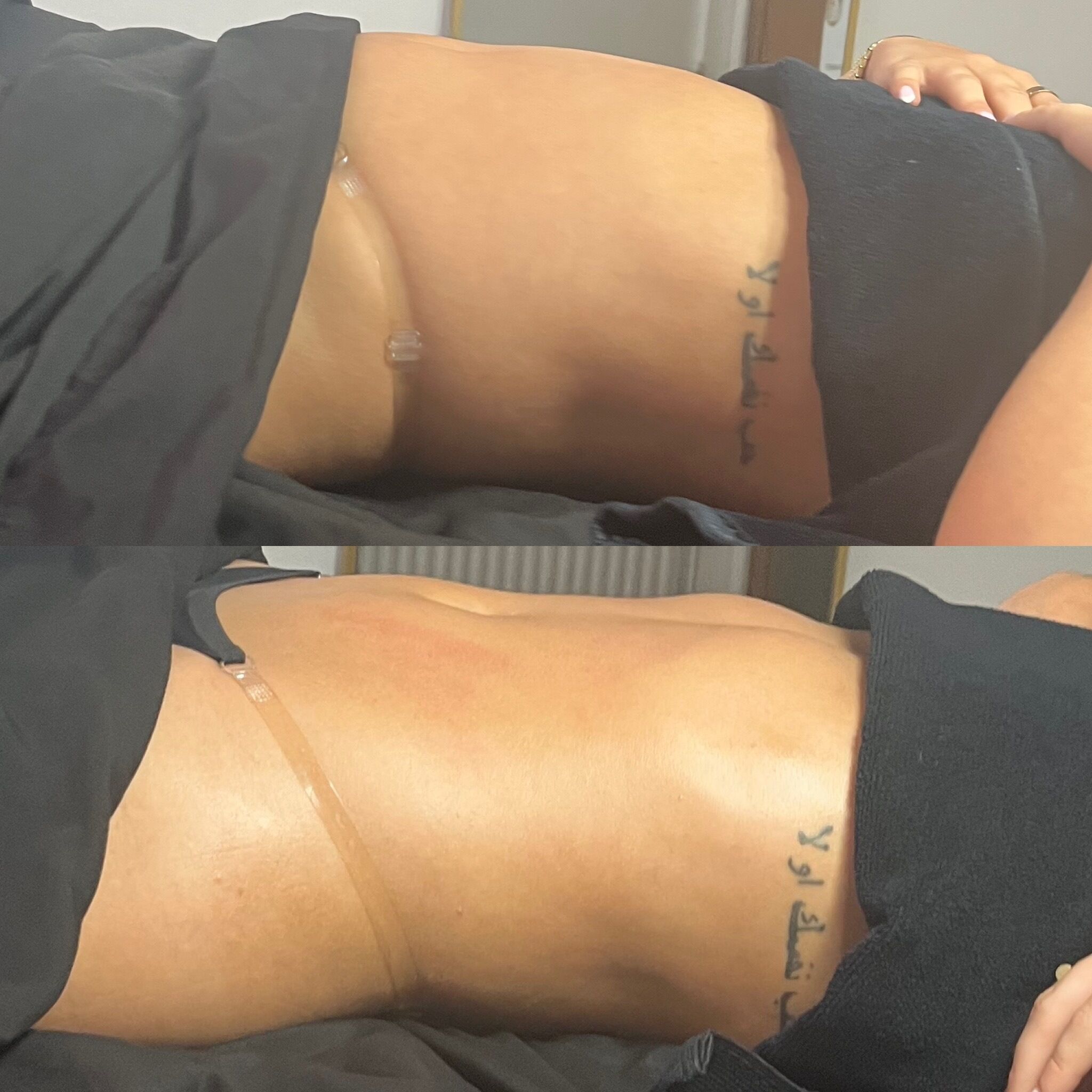 Before & after – lymphatic drainage